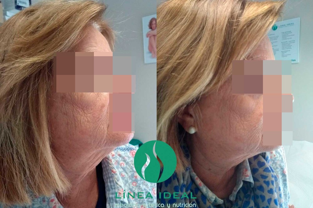 Before and After Result